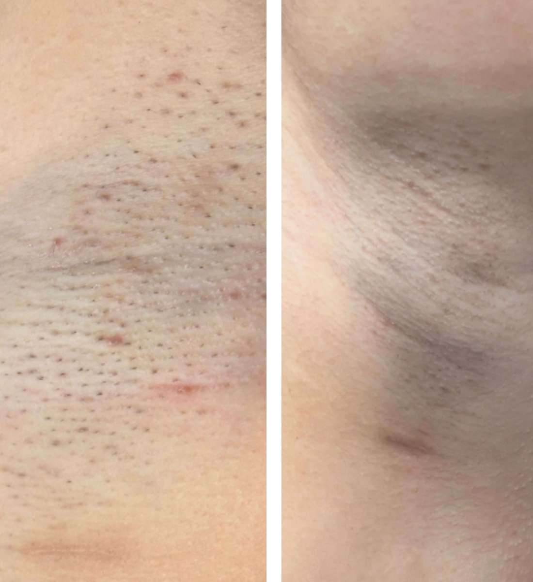 Resultaat laserontharing, voor en na